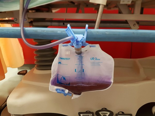 MD News Daily - Purple Urine Bag Syndrome: What You Need to Know About this Rare Illness