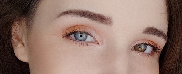 MD News Daily - Heterochromia Iridis