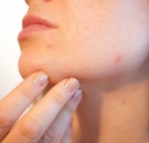 MD News Daily - Study Finds a ‘Unique Medical Structure’ of an Acne Treatment
