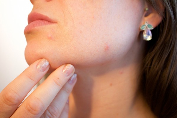 MD News Daily - Study Finds a ‘Unique Medical Structure’ of an Acne Treatment