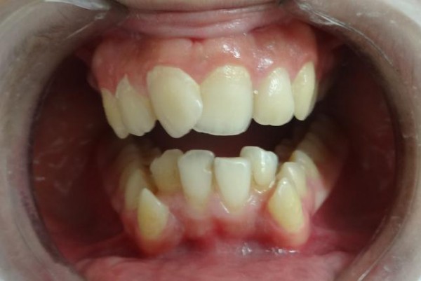 MD News Daily - 11-Year-Old Girl Has More Teeth Than She Should Only Have: Here Are Facts About Hyperdontia
