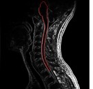 MD News Daily - Team of Researchers Identifies Mechanisms for the Restoration of Myelin Sheaths Following an Injury or Multiple Sclerosis