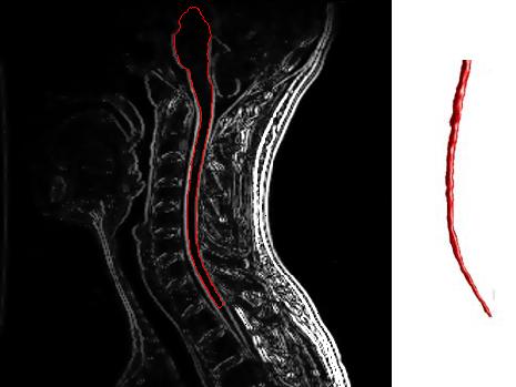 MD News Daily - Team of Researchers Identifies Mechanisms for the Restoration of Myelin Sheaths Following an Injury or Multiple Sclerosis