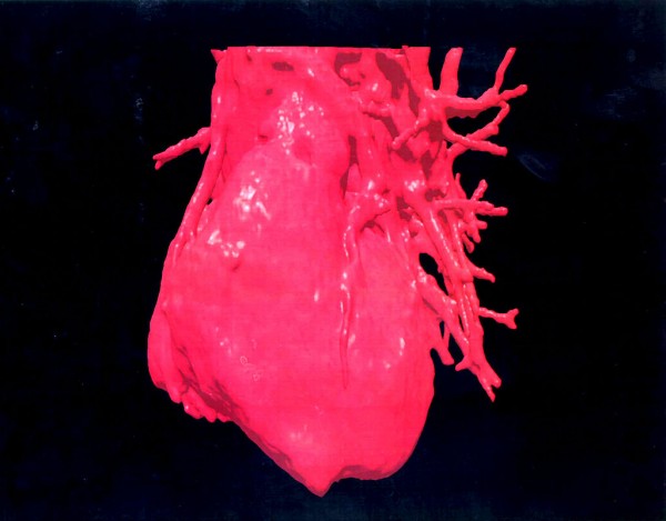 MD News Daily - Three Dimensional (3 D Image Displays A Computerised Visualization Of A Human Heart