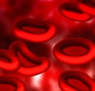 MD News Daily- End-Organ Damage Associated With Sickle Cell Disease Increases Economic Burden Among Patients