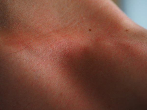 MD News Daily- Pale Melanomas Are More Likely Linked to An Inherited Albino Gene MD News Daily- Pale Melanomas Are More Likely Linked to An Inherited Albino Gene