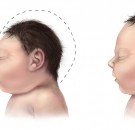 MD News Daily - Microcephaly: Here’s Something You Should Know for Future Pregnancies