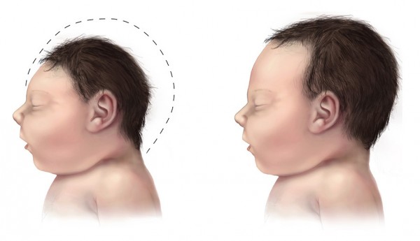 MD News Daily - Microcephaly: Here’s Something You Should Know for Future Pregnancies