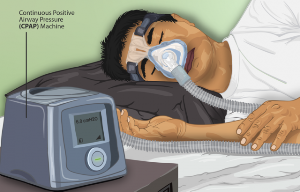 MD News Daily - Researchers Find Link Between Obstructive Sleep Apnea and Increased Hospitalization From Flu Infection