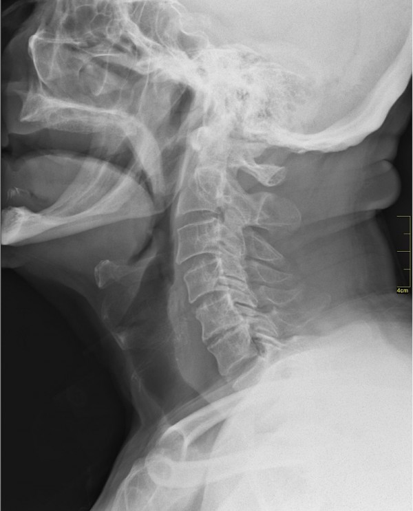 Throat Medical X-Ray Imaging