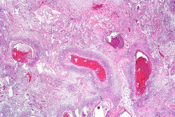 MD News Daily - Researchers Detect Rapid Method of Separating ‘Tumor-Targeting T Cells’ Could Boost Personalized Cancer Treatment MD News Daily - Researchers Detect Rapid Method of Separating ‘Tumor-Targeting T Cells’ Could Boost Personalized Cancer Treatment