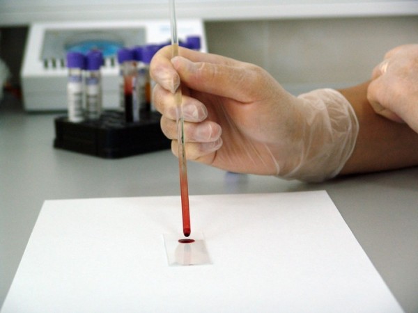 MD News Daily - Blood Test That Can Detect Alzheimer’s Disease Now Available for Clinical Use