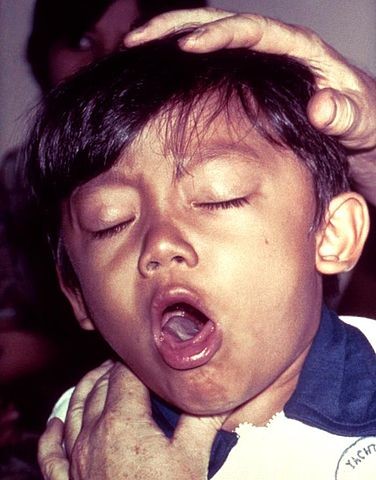 Coughing, Whooping Cough, Child