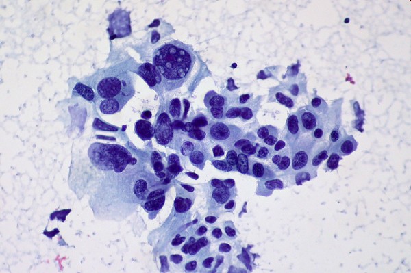 Non-small Cell Carcinoma of the Lung Non-small Cell Carcinoma of the Lung