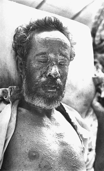 Smallpox Smallpox