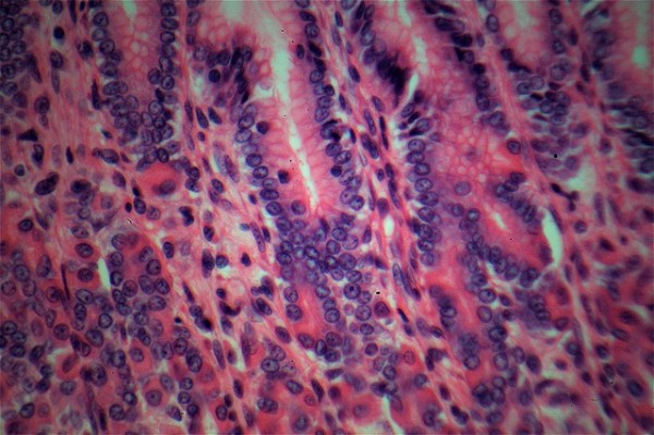 Edible Magnetic Bacteria Helps Detect and Screen Stomach Cancer