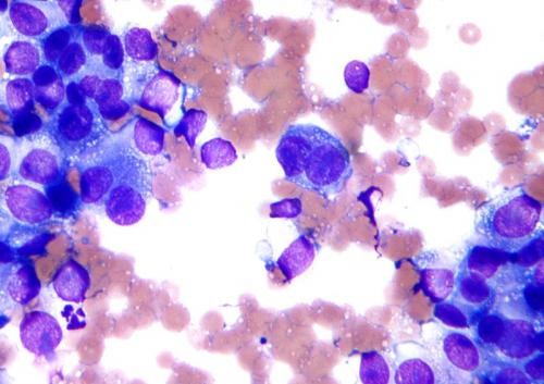 Micrograph of malignant melanoma. Cytology specimen.