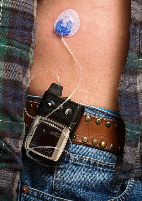 Insulin Pumps are More Effective in Controlling Blood Glucose Levels in Diabetics Insulin Pumps are More Effective in Controlling Blood Glucose Levels in Diabetics