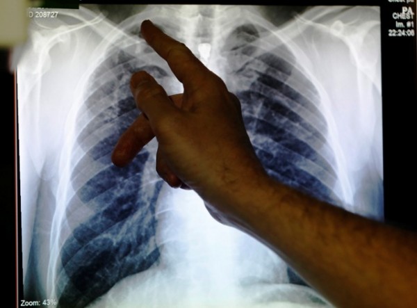 Incidence of Childhood Tuberculosis is 25 Percent Higher than Past Estimates Incidence of Childhood Tuberculosis is 25 Percent Higher than Past Estimates