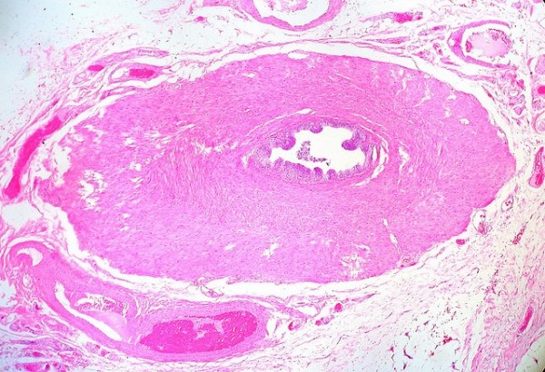 Vasectomy Increases the Risk Developing Aggressive Forms of Prostate Cancer Vasectomy Increases the Risk Developing Aggressive Forms of Prostate Cancer