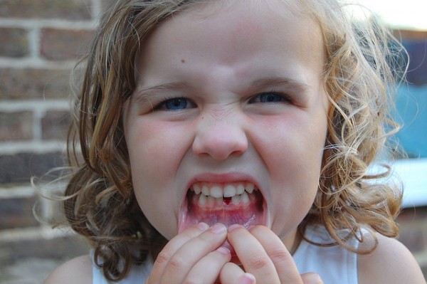 Over 500 Children with Cavities are Hospitalized Every Week