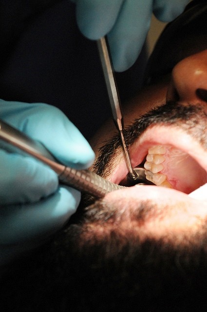 Dental Surgeons Extract 232 Teeth from Teen’s Mouth