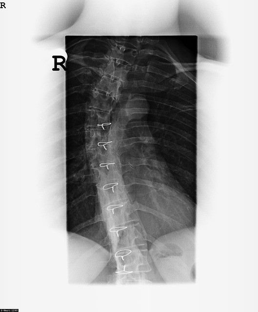X Ray Image Bone Spine Move Eddy
