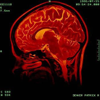 Brain scan study shows clot-busting drug benefits stroke patients