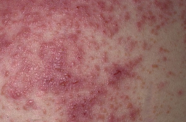 Yale researchers beat untreatable eczema with arthritis drug