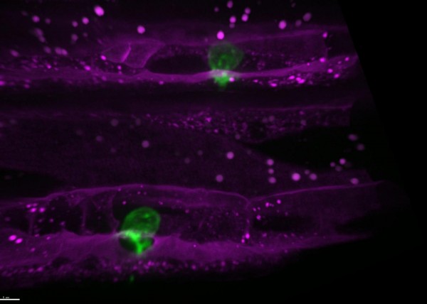 Cell Invasion in C. elegans Worms Mimics What Happens in Tumors