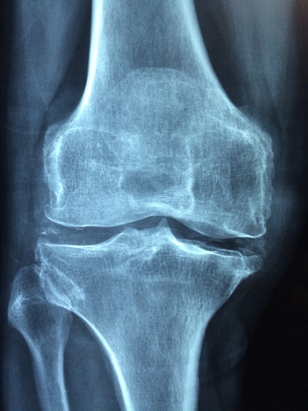 Study examines long-term opioid use in patients with severe osteoarthritis (Image)