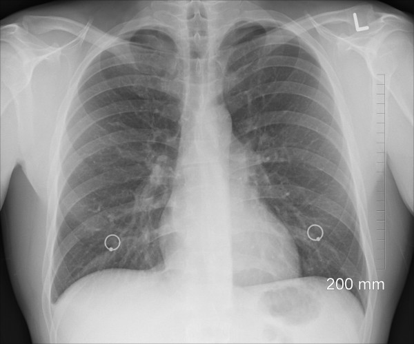 Lung Xray