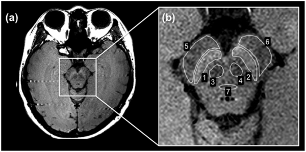 Neuromelanin-sensitive MRI (IMAGE)
