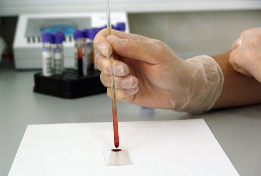 MD News Daily - Blood Test That Can Detect Alzheimer’s Disease Now Available for Clinical Use