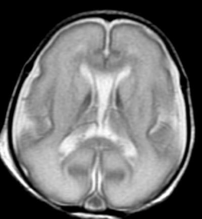 15 Weeks Premature, brain 15 Weeks Premature, brain