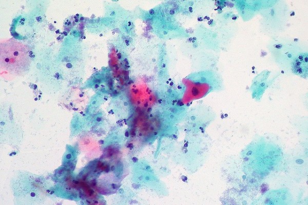 FDA Approves HPV Tests as a Primary Screening Tool for Cervical Cancer FDA Approves HPV Tests as a Primary Screening Tool for Cervical Cancer