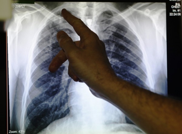 Study Confirmed One Million cases of TB attacks in Children Study Confirmed One Million cases of TB attacks in Children