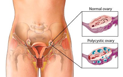 Polycystic ovary syndrome