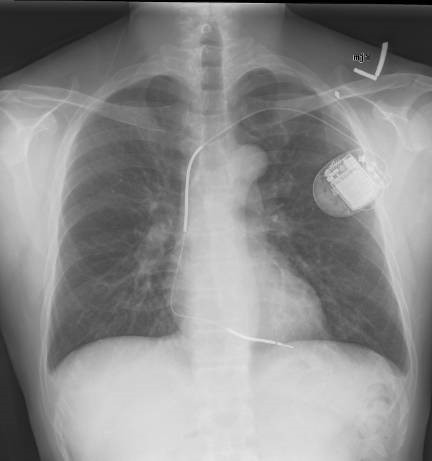 Implantable Defibrillator Implantable Defibrillator