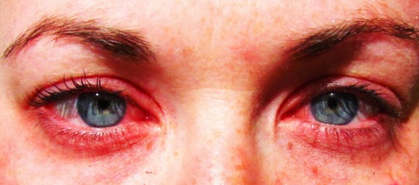 Allergies, eyes