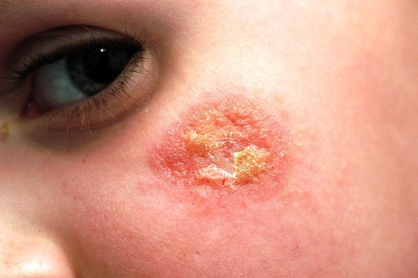 Eczema most likely to reoccur during Adulthood in Those who were Affected in Childhood