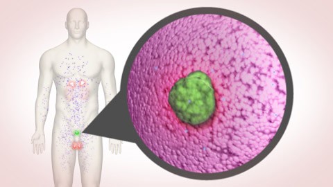 prostate cancer prostate cancer
